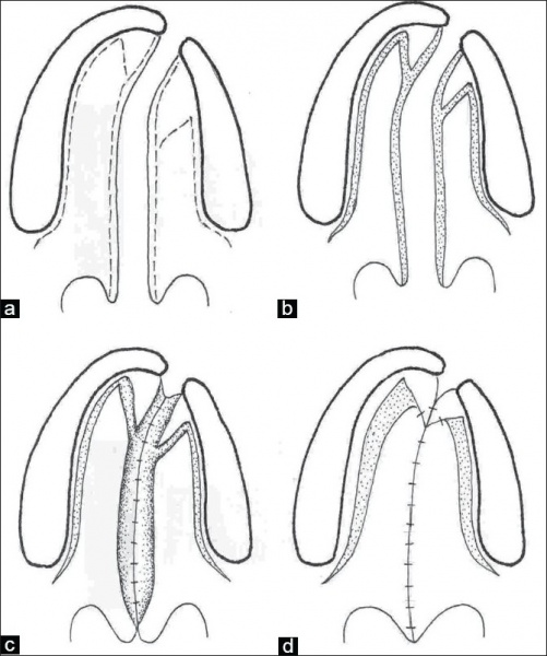 File:Veau-Wardill-Kilner technique of palate repair in a unilateral cleft lip and palate.jpg
