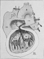 Fig. 30 Cor biatriatrum triloculare with malposed interventricular septum