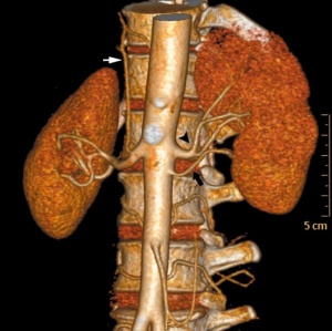Accessory Renal Arteries