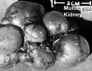 Multicystic kidney