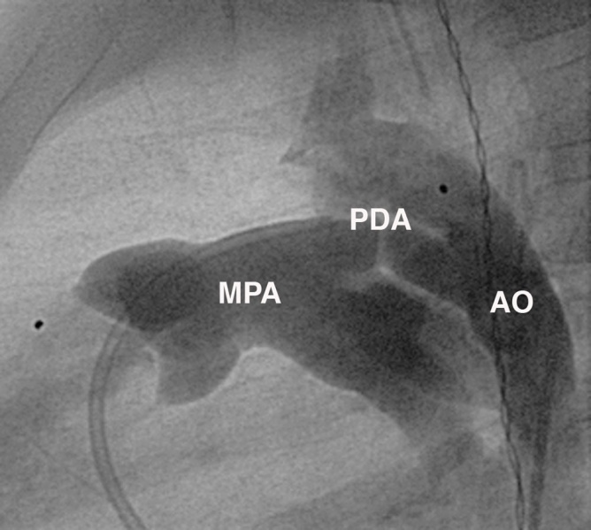 File:Patent ductus arteriosus angiogram.jpg