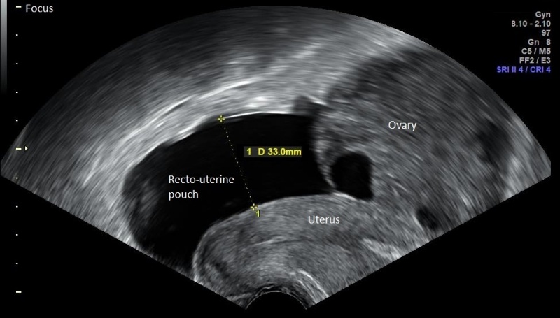 File:Vaginal Ultrasonography in Sagittal Plane.jpg