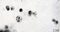 Fig. 238. A phagocytic pseudo-Hofbauer cell. No. 645, slide 2. X650.