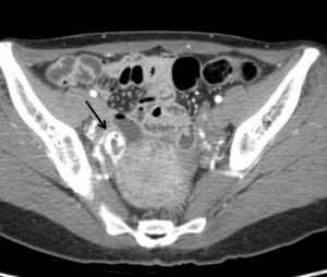 Ectopic pregnancy CT 01.jpg