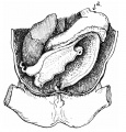 fetus 63 mm