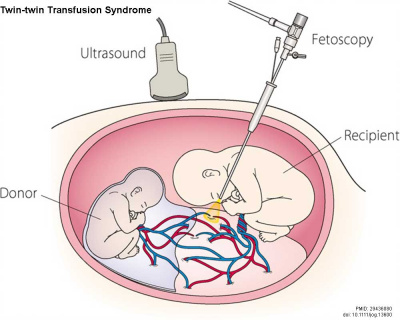 Twin–twin transfusion syndrome 03.jpg