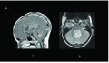 Fig 29 MRI pediatric medulloblastomas Z5018156