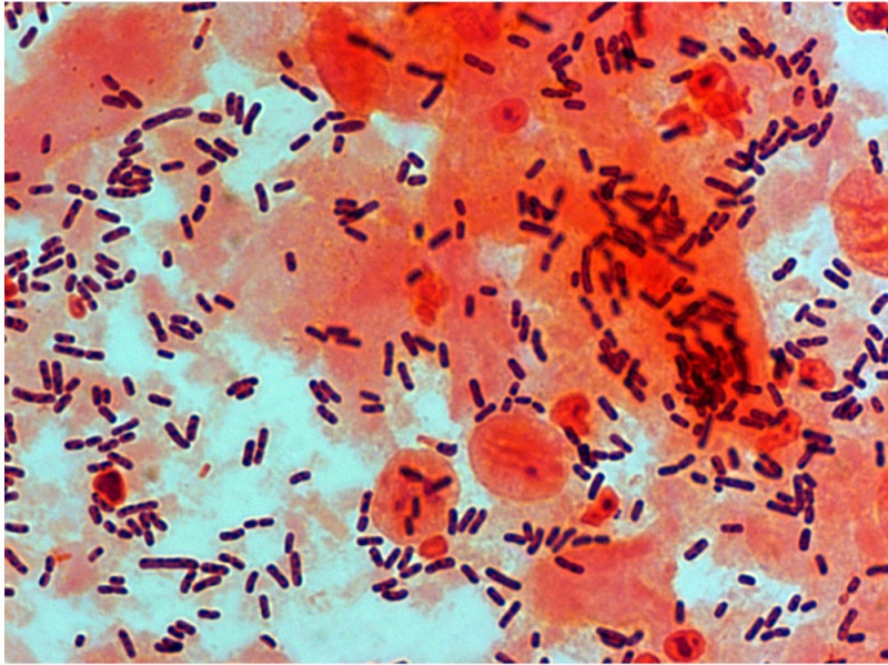 File:Bacteria - gram-stained vaginal smear 02.jpg