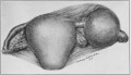 Fig. 56. A Hematoma of the Tube