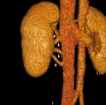 Multiple right renal veins