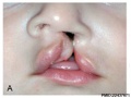Unilateral cleft lip