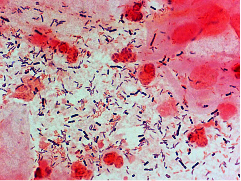 File:Bacteria - gram-stained vaginal smear 10.jpg