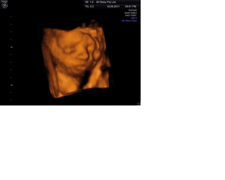 File:Ultrasound Demonstrating Facial Features.jpg