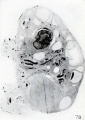 Fig. 78. Longitudinal section of right ovary, showing carcinomatous nodule to the right. No. 865. X2.