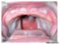Complete Cleft Palate (Completely involving the secondary palate)