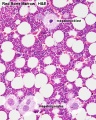 Bone Marrow Megakaryocyte