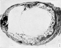 Fig. 1. Cross-section of twin hydatiform chorionic vesicles within the tube. (Specimen No. 825.) X3.