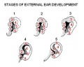 The image depicts the development of the pinna through the fetal development stages