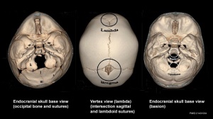 Skull CT normal sutures 02.jpg
