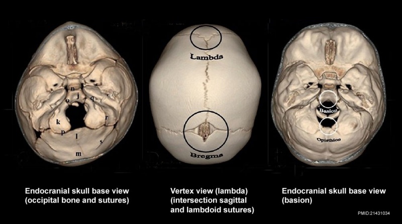 File:Skull CT normal sutures 02.jpg