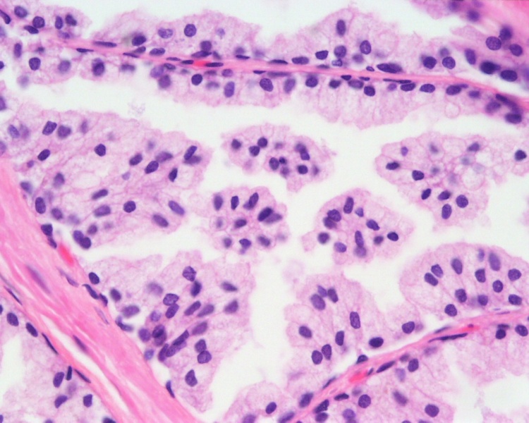 File:Prostate histology 08.jpg