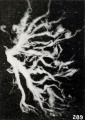 Fig. 289. Villous nodules and lichen-like streamers on a villous tree. No. 2204. X7.2.