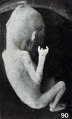 Fig. 90. Anomaly of left hand of No. 306a. Only the thumb and little finger are normal.
