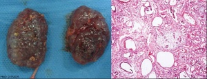 Multicystic kidney and histology