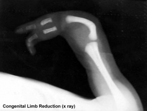 Congenital limb reduction xray.jpg
