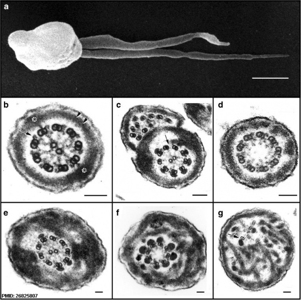 File:Human sperm pathologies EM01.jpg