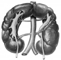 Horseshoe kidney with superior isthmus.