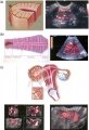 Ultrasound uterine and ovarian vascularity