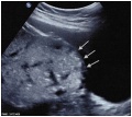 Ultrasound placenta accreta bladder wall interface