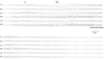 EEG in Angelman syndrome mice with a maternal deletion from Ube3a to Gabrb3.jpg