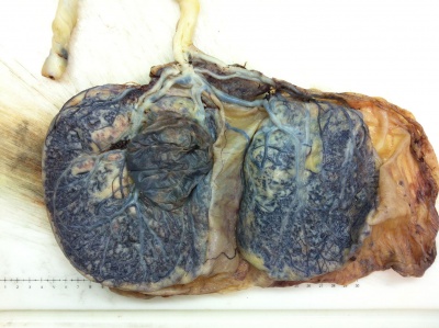 Bilobed placenta with velamentous cord insertion.jpg