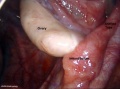 Human ovary and tube as viewed by laparoscopy