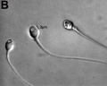 Human vacuolated spermatozoon