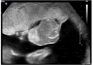Placental chorioangioma ultrasound 01.jpg