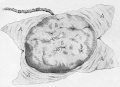 Placenta Maternal Side