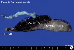 Placenta previa and increta 02.jpg