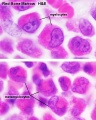 Myelocyte and Metamyelocytes