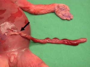 Placenta- umbilical cord torsion.jpg